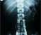Рентгенографическое изображение лимфатических сосудов таза
